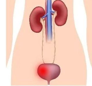 The reasons for the development of cystitis in women