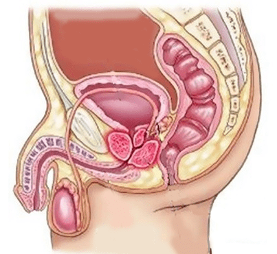 Causes of cystitis in men
